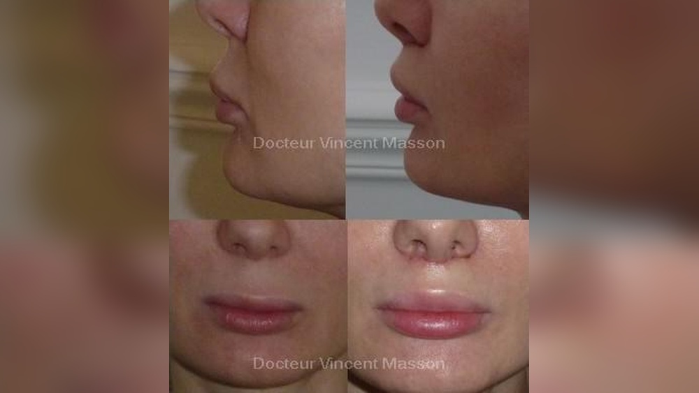 Augmentation Des Lèvres Sans Chirurgie
