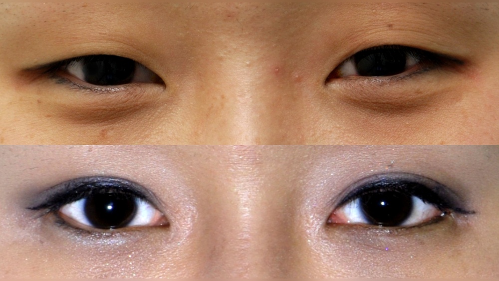 Blépharoplastie