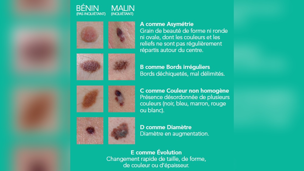 Bouton Sur Grain De Beauté