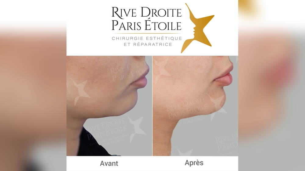 Génioplastie Sans Chirurgie
