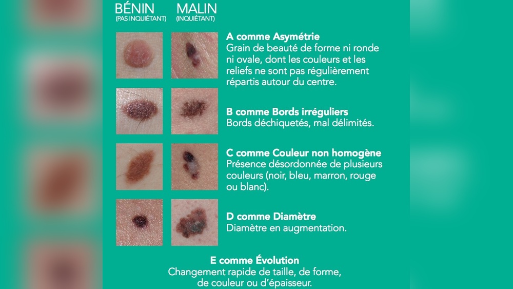 Grain De Beauté Avec Points Noirs