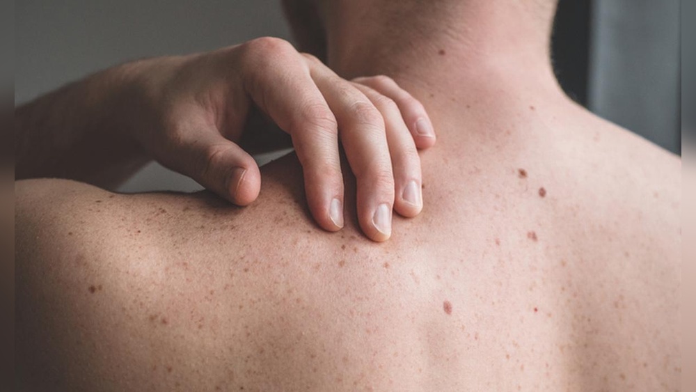 Grain De Beauté Qui Apparaît Du Jour Au Lendemain