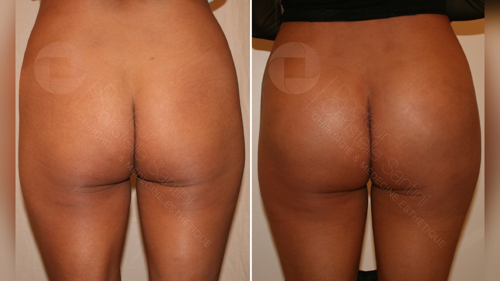 Implant Fessier