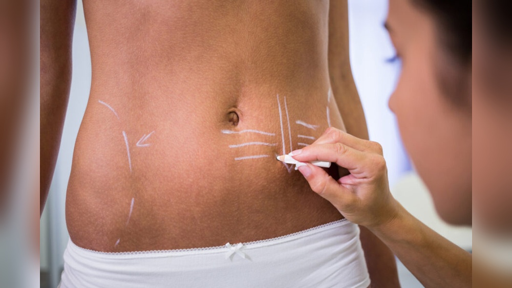 Liposuccion Sans Chirurgie