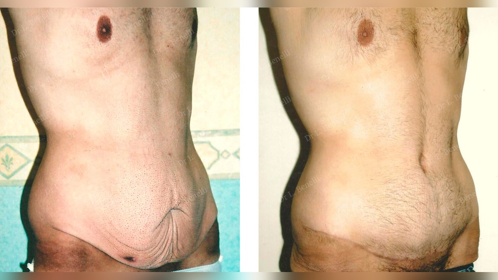 Pectoraux Sans Chirurgie