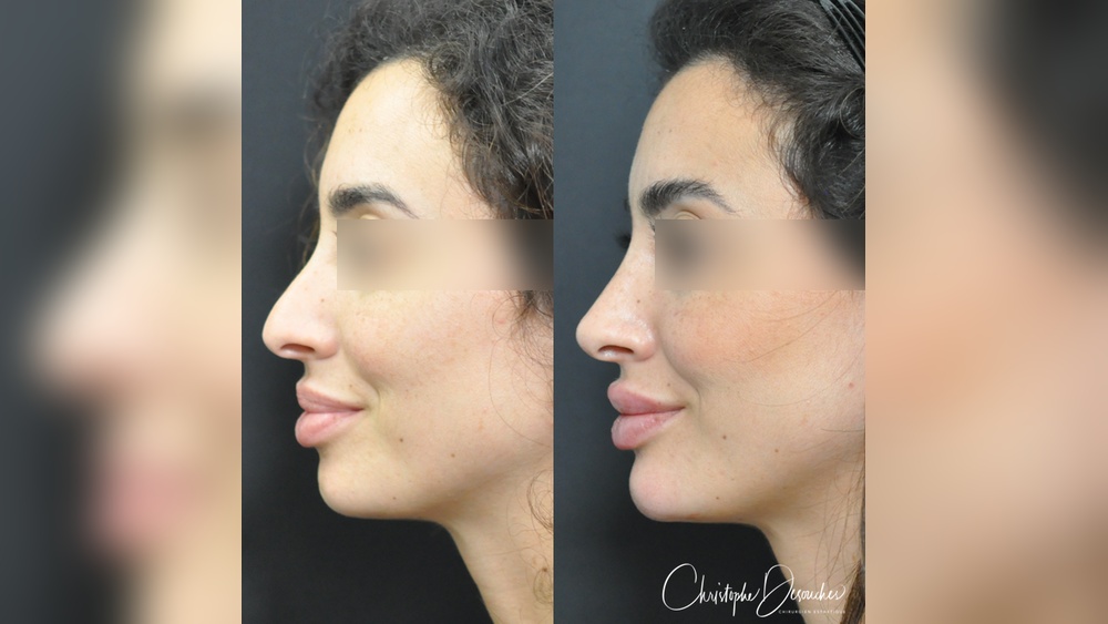 Rhinoplastie Sans Chirurgie
